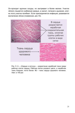 21
Он проходит крупные сосуды, но застревает в более мелких. Участок
лёгкого лишается снабжения кровью, а значит, питания и дыхания, клет-
ки этого участка погибают. Если присоединяется инфекция, развивается
воспаление лёгких (пневмония, рис.14).
Рис. 9. А – «Сердце в сеточку» – разрастание нерабочей ткани среди
рабочих клеток сердца. Рабочие клетки розового цвета, а нерабочая
ткань бледная, почти белая. 9Б – ткань сердца здорового человека.
Увел. в 100 раз
 
