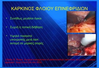 ΚΑΡΚΙΝΟΣ ΦΛΟΙΟΥ ΕΠΙΝΕΦΡΙΔΙΩΝ
• Συνήθως μεγάλοι όγκοι
• Συχνή η τοπική διήθηση
• Υψηλό ποσοστό
υποτροπής μετά λαπ.
εκτομή σε μερικές σειρές
J Datta, R. Roses Surgical management of adrenocortical carcinoma: an evidence-based
αpproach Surg Oncol Clin Am 2015;
 