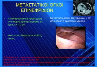 METAΣΤΑΤΙΚΟΙ ΟΓΚΟΙ
ΕΠΙΝΕΦΡΙΔΙΩΝ
• Η λαπαροσκοπική προσέγγιση
είναι συχνά εφικτή και ριζική σε
όγκους < 10 cm
• Καλά αποτελέσματα σε πολλές
σειρές
Μετάσταση δεξιού επινεφριδίου 9 cm
από καρκίνο αριστερού νεφρού
G. Zografos et al . Laparoscopic adrenalectomy for large adrenal metastasis from contralateral renal cell
carcinoma. J.S.L.S 2007;11(2):261-265
Moreno P et al Adrenalectomy for solid tumor metastases: results of a multicenter European study.
Surgery 2013;154(6):1215-22;.
 