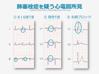 肺塞栓症を疑う⼼電図所⾒
⼼電図所⾒ 感度(％) 特異度(％) LR(+)
①SⅠQⅢTⅢ
­  I誘導でS波(+)
­  III誘導でQ波(+)
­  III誘導で陰性T波
8.5
22.3
24.6
30.5
97.7
82.9
85.8
85.5
3.7 [2.5-5.4]
1.5 [1.3-1.9]
1.7 [1.4-2.1]
1.8 [1.5-2.1]
②陰性T波
­  V1-4誘導
­  V1-3誘導
­  V1-2誘導
­  V1誘導
7.35
10.5
14.4
37.9
98.0
96.0
91.9
66.0
3.7 [2.4-5.5]
2.6 [1.9-3.6]
1.8 [1.3-2.3]
1.1 [1.0-1.3]
③右脚ブロック
­  完全右脚ブロック
­  不完全右脚ブロック
4.8
3.1
97.2
97.7
1.7 [1.0-2.7]
1.4 [0.8-2.5]
④頻脈(>100回/分) 28.8 84.3 1.8 [1.5-2.2]
※6049名のPE疑い患者の⼼電図を評価(内354名がPEと診断)
Ann Emerg Med 2010;55:331-5
 