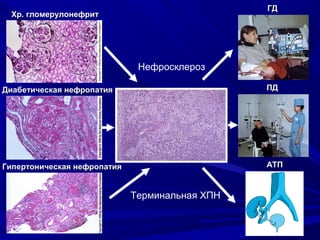 Хр. гломерулонефритХр. гломерулонефрит
Диабетическая нефропатияДиабетическая нефропатия
Гипертоническая нефропатияГипертоническая нефропатия АТПАТП
ПДПД
ГДГД
Нефросклероз
Терминальная ХПН
 