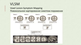 VLSM
Voxel Lesion-Symptom Mapping
Повоксельное картирование симптом-поражение
 