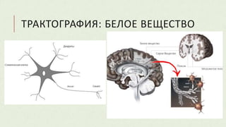 ТРАКТОГРАФИЯ: БЕЛОЕ ВЕЩЕСТВО
 