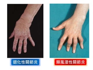 退化性關節炎 類風溼性關節炎
 