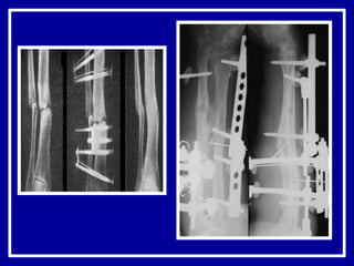 ложные суставы