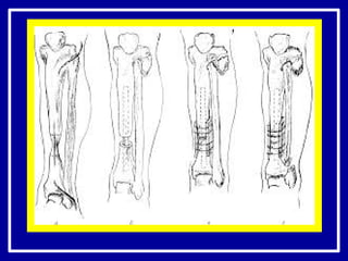 ложные суставы