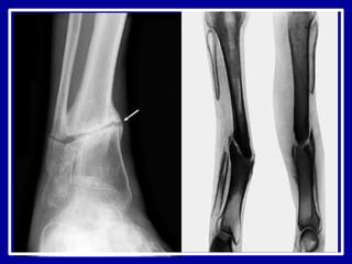 ложные суставы