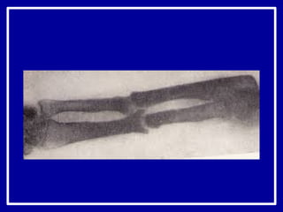 ложные суставы