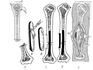 ложные суставы