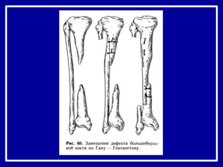 ложные суставы