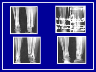 ложные суставы