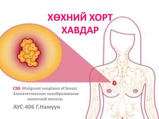 ХӨХНИЙ ХОРТ
ХАВДАР
С50: Malignant neoplasm of breast
Злокачественное новобразование
молочной железы
АУС-406 Г.Намуун
 