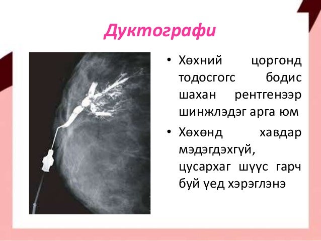 Хөхний хорт хавдар