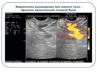 Варикозное расширение вен малого таза –
причина хронической тазовой боли
 