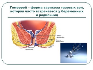 Геморрой – форма варикоза тазовых вен,
которая часто встречается у беременных
и родильниц
 