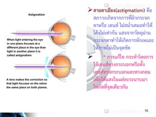 18
สายตาเอียง(astigmatism) คือ
สภาวะเกิดจากการที่ผิวกระจก
ตาหรือ เลนส์ ไม่สม่าเสมอทาให้
โค้งไม่เท่ากัน แสงจากวัตถุผ่าน
กระจกตาทาให้เกิดการหักเหและ
ให้ภาพไม่เป็นจุดชัด
 * การแก้ไข กระทาโดยการ
ใช้เลนส์ทรงกระบอกหรือทั้ง
เลนส์ทรงกระบอกและทรงกลม
เพื่อให้แสงในแต่ละระนาบมา
โฟกัสที่จุดเดียวกัน
 