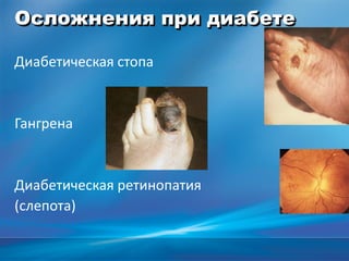 Осложнения при диабете
Диабетическая стопа
Гангрена
Диабетическая ретинопатия
(слепота)
 