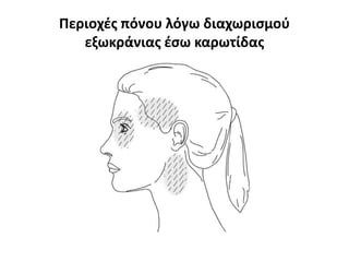 Περιοχές πόνου λόγω διαχωρισμού
εξωκράνιας έσω καρωτίδας
 