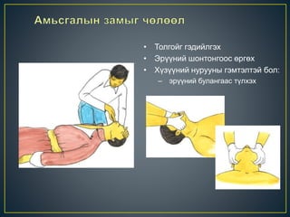 • Толгойг гэдийлгэх
• Эрүүний шонтонгоос өргөх
• Хүзүүний нурууны гэмтэлтэй бол:
– эрүүний булангаас түлхэх
 