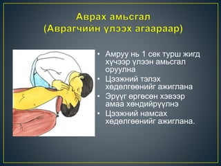 • Амруу нь 1 сек турш жигд
хүчээр үлээн амьсгал
оруулна
• Цээжний тэлэх
хөдөлгөөнийг ажиглана
• Эрүүг өргөсөн хэвээр
амаа хөндийрүүлнэ
• Цээжний намсах
хөдөлгөөнийг ажиглана.
 