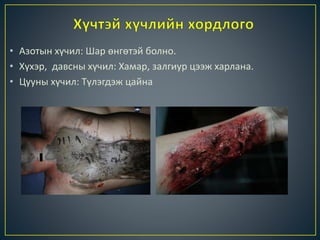 • Азотын хүчил: Шар өнгөтэй болно.
• Хүхэр, давсны хүчил: Хамар, залгиур цээж харлана.
• Цууны хүчил: Түлэгдэж цайна
 