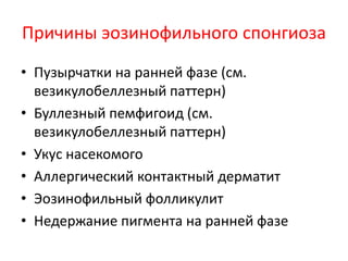 Спонгиоз + эозинофилы в эпидермисе
• Возможные причины:
• Эозинофильная реакция на лекарство.
• Кроме этого, эозинофилия иногда
сопровождает пузырчатки. При пузырчатке
спонгиоз связан с акантолизом с утратой
межклеточных мостиков и округлением
шиповидных клеток.
• Пузырчатки рассматриваются в
великулобуллезном паттерне.
 