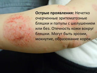 Атопический дерматит
• Синонимы: экзема, нейродермит,
экссудативно-катарральный диатез
• Это острое, подострое или хроническое
рецидивирующее заболевание кожи,
которое часто начинается в младенчестве и
характеризуется выраженным зудом с
расчесами и лихенификацией
(гиперплазией кожи).
 
