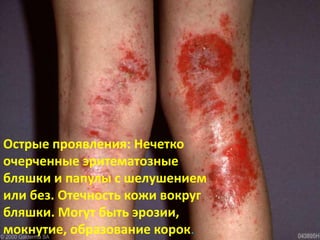 Острые проявления: Нечетко
очерченные эритематозные
бляшки и папулы с шелушением
или без. Отечность кожи вокруг
бляшки. Могут быть эрозии,
мокнутие, образование корок.
 