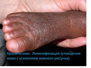 Острые проявления: Нечетко
очерченные эритематозные
бляшки и папулы с шелушением
или без. Отечность кожи вокруг
бляшки. Могут быть эрозии,
мокнутие, образование корок.
 