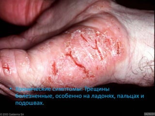 =
• Хронические: Лихенификация (утолщение
кожи с усилением кожного рисунка).
 