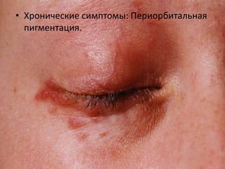 • Хронические симптомы: Трещины
болезненные, особенно на ладонях, пальцах и
подошвах.
 