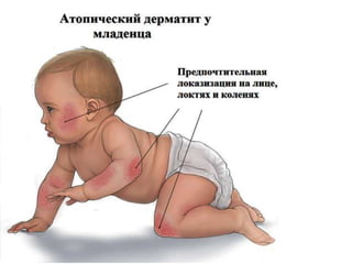 Атопический дерматит
• Распределение высыпаний:
• Предпочтительно на сгибательных
поверхностях, на передней и боковых
поверхностях шеи, веках, лбу, лице,
запястьях, тыле стоп и кистей.
• При тяжелом течении – высыпания
генерализованные.
 