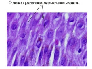 Спонгиотический паттерн
• Спонгиоз – это накопление жидкости между кератиноцитами
эпидермиса, что приводит к растяжению десмосом (межклеточных
мостиков). Это особенно заметно в шиповидном слое.
 