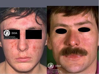 Себореный дерматит
• Неадекватная иммунная реакция кожи на обычный обитатель
кожных покровов малассезию.
• Malassezia furfur – это кожный грибок, который обитает на
коже всех млекопитающих.
• Его больше там, где много сальных желез.
• Его количество увеличивается при усилении сальности кожи.
• У некоторых людей возникает реакции непереносимости
малассезии – малассезиаз.
• Малассезиазы проявляются в форме перхоти, отрубевидного
лишая и себорейного дерматита.
• Себорейный дерматит имеет характерное распределение
элементов на коже. Там, где больше сальных желез.
 