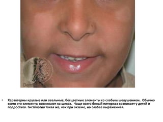 Белый питириаз
• Белый питириаз довольно распространенное заболевание,
проявляющееся как мягкая форма экземы. Причина его неизвестна.
 