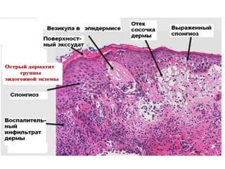 • Характерны круглые или овальные, бесцветные элементы со слабым шелушением. Обычно
всего эти элементы возникают на щеках. Чаще всего белый питириаз возникает у детей и
подростков. Гистология такая же, как при экземе, но слабее выраженная.
 
