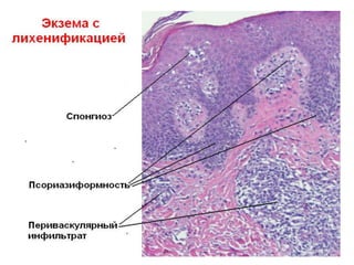 • Примечание: При себорейном дерматите в роговом слое видны грибы.
 