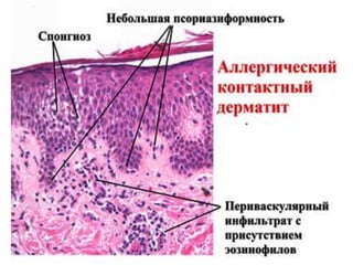 Различия между аллергическим и ирритативным
контактным дерматитом
• Ирритативный дерматит развивается сразу (спустя минуты
или часы после воздействия вещества на кожу),
аллергический контактный дерматит всегда имеет
определенный латентный период.
• При контактном дерматите эритема или высыпания
возникают непосредственно в зоне контакта, тогда как при
АКД сыпь может появиться на любом участке кожи.
• Простой дерматит исчезает после прекращения
взаимодействия с раздражающим веществом. АКД не всегда
регрессирует при исключении контакта с аллергеном.
• Гистология аллергического контактного дерматита такая же,
как при экземе, но в периваскулярных инфильтратах и в
воспалительном инфильтрате дермы присутствуют
эозинофилы, что является признаком, отличающим его он
других спонгиотических дерматитов.
 