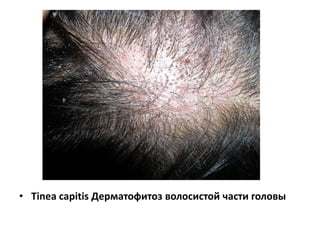 Дерматофитозы
• Грибковые инфекции эпидермиса дают
гистологическую картину спонгиотического
дерматита.
• Отличием от экземы является присутствие
грибов в роговом слое.
 