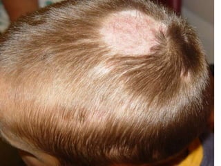 • Tinea capitis Дерматофитоз волосистой части головы
 