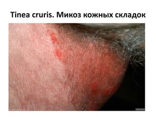 Tinea faciale
 
