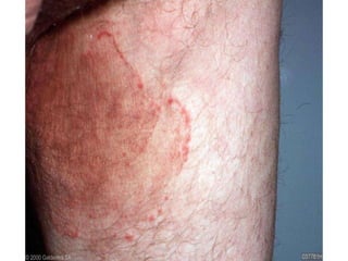 Tinea cruris. Микоз кожных складок
 