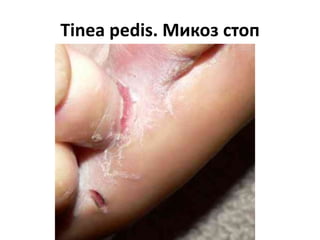 Tinea Manuum. Микоз рук
 