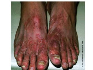 Tinea pedis. Микоз стоп
 