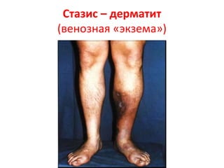 Соскоб кожи. Препарат с КОН.
Микроскопия в темном поле.
 