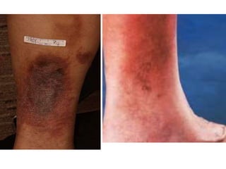 Стазис – дерматит
(венозная «экзема»)
 