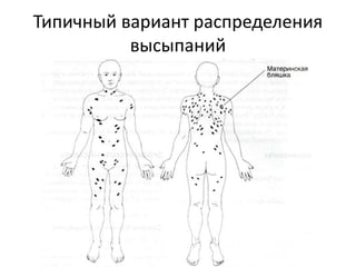 Розовый лишай PITYRIASIS ROSEA
• При розовом лишае иногда бывает
отчетливый псориазиформный паттерн
гистологических изменений и диагностику
можно начинать с него.
• Однако псориазиформный паттерн бывает
непостоянно.
• Всегда присутствует спогиотический
паттерн.
 