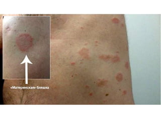 Типичный вариант распределения
высыпаний
 