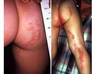 Полосовидный (линейный) лишай.
(Lichen striatus)
• Редкий дерматоз неизвестно этиологии, который
проходит без лечения. Обычно он возникает у детей
в возрасте от 5 до 15 лет, но может развиваться и у
взрослых.
• Характеризуется полосовидной односторонней
сыпью, состоящей из мелких бледно-розовых,
слегка возвышающихся узелков величиной 2-3 мм в
диаметре, чаще локализующихся на нижних
конечностях.
• Зуд и боль отсутствуют, возможны гипостезии и
другие симптомы периферического неврита.
 