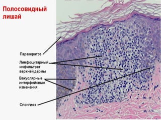 Гистология
• Обязательно спонгиоз и вакуолярные
интерфейсные изменения.
• Спонгиоз чаще умеренный.
• Часто, но необязательно, псориазиформность.
• Часто паракератоз.
• Лимфоцитарный инфильтрат дермы вблизи
базальной мембраны, а также вокруг
поверхностных сосудов.
• Иногда лимфоцитарный инфильтрат вблизи
придатков кожи.
 